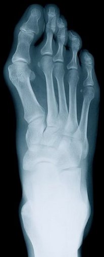 Montgomery Podiatrist | Montgomery Rheumatoid Arthritis | AL | Mulberry Foot Care, LLC |